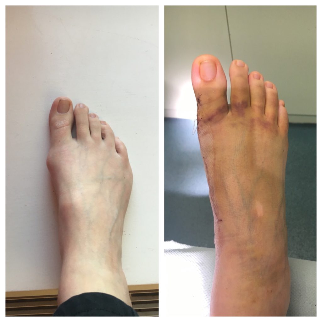 mid-foot-fusion-surgery-3-weeks-on