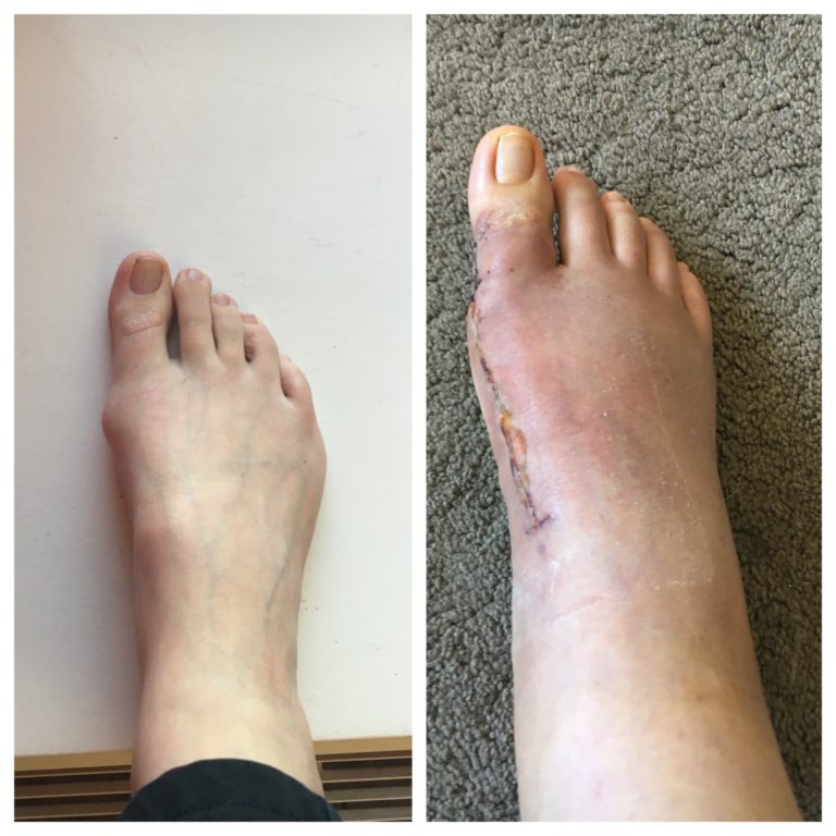 mid-foot-fusion-surgery-3-weeks-on